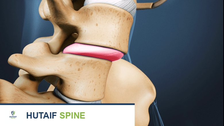 عرض مقرب لتصوير ثلاثي الأبعاد للعمود الفقري القطني، مع تسليط الضوء على القرص المنزلق باللون الأحمر.