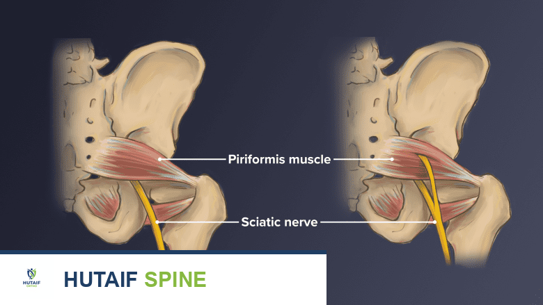 صورة للجانب الأيسر من حوضين تظهر التباين التشريحي للعصب الوركي أثناء مروره أسفل العضلة الكمثرية وعبرها.