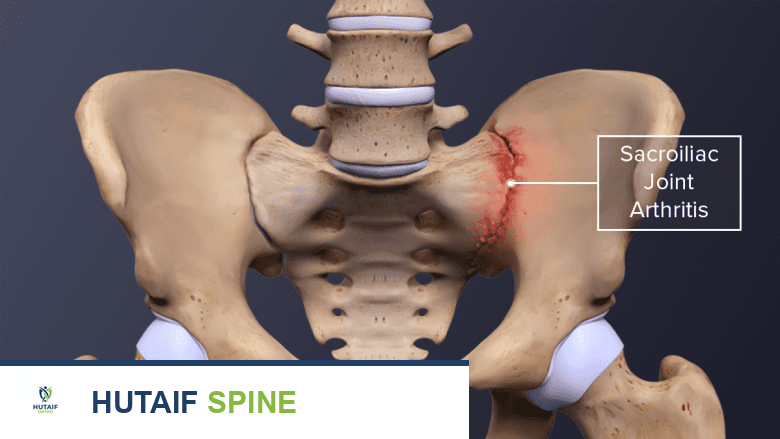 التهاب المفصل العجزي الحرقفي: الأسباب، الأعراض، التشخيص، والعلاج في صنعاء