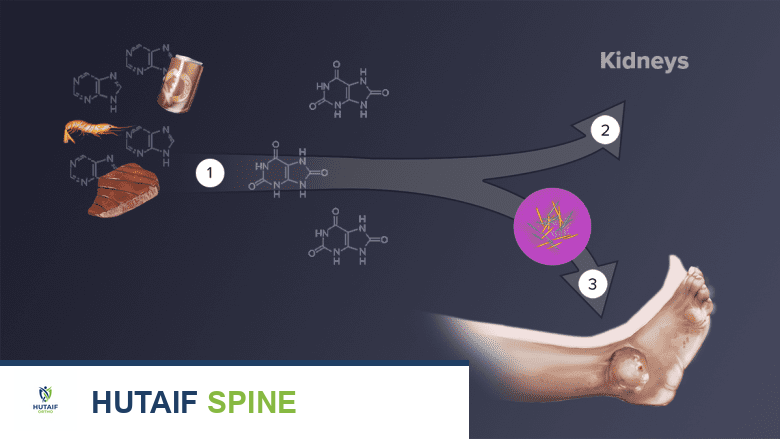 البيورينات الموجودة في الأطعمة يتم استقلابها بواسطة الجسم وتحويلها إلى حمض اليوريك (1). يتم ترشيح حمض اليوريك عادة من مجرى الدم بواسطة الكلى (2). يمكن أن يؤدي زيادة حمض اليوريك في مجرى الدم إلى تكوين بلورات حمض اليوريك في مفصل واحد أو أكثر