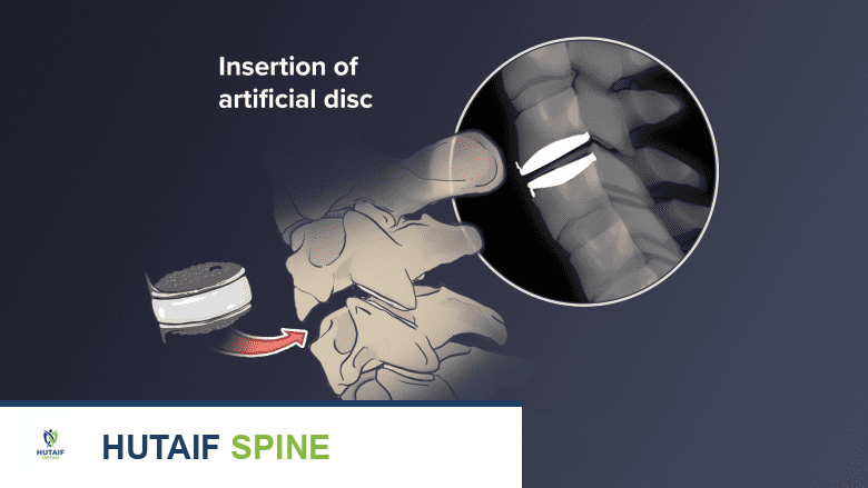 جراحة تضيق الثقبة العنقية: دليل شامل للعلاج والتعافي مع الأستاذ الدكتور محمد هطيف