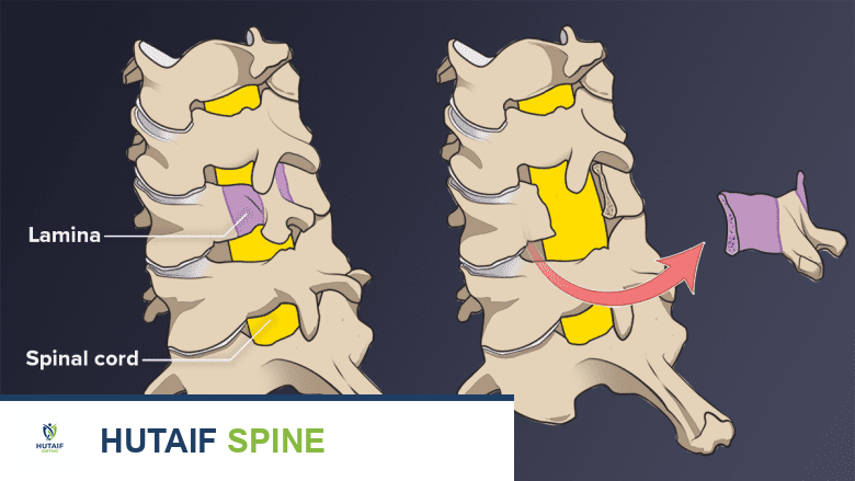 توضيح لإجراء استئصال الصفيحة الفقرية العنقية