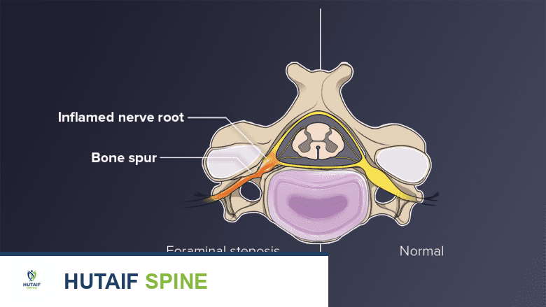 An illustration showing cervical foraminal Stenosis.