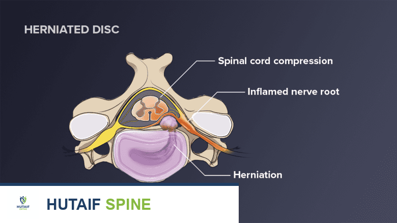 An illustration showing cervical herniated disc.