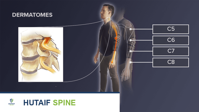 Illustration of areas affected by cervical nerve root causing radiculopathy