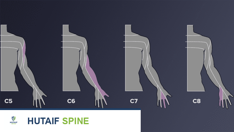 illustration of the cervical dermatomes affected by cervical radiculopathy