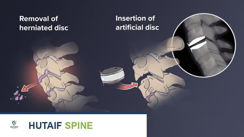 تصوير يوضح استبدال القرص العنقي الأمامي.