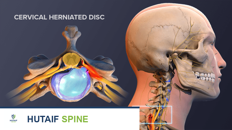 تصوير يوضح تشريح الرأس والرقبة وفقرة عنقية بها انزلاق غضروفي.