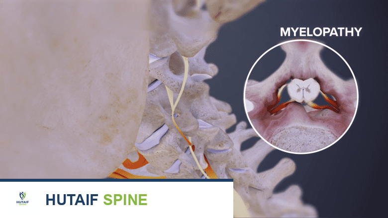 تضيق القناة الشوكية العنقية مع اعتلال النخاع الشوكي: دليل شامل من الأستاذ الدكتور محمد هطيف