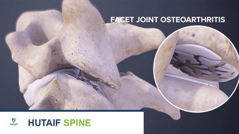 حقن المفاصل الوجيهية في الرقبة والظهر: دليل شامل لمرضى آلام العمود الفقري