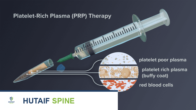 صورة توضيحية لـ حقن المفاصل الوجيهية في الرقبة والظهر: دليل شامل لمرضى آلام العمود الفقري