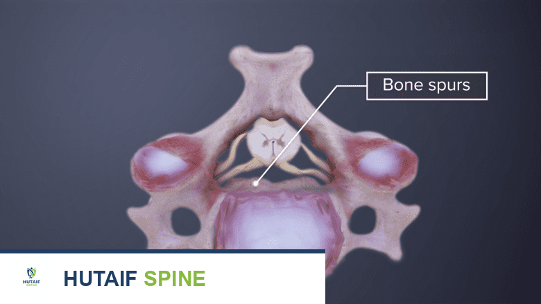 توضيح طبي يظهر فقرة عنقية مع نتوء عظمي.