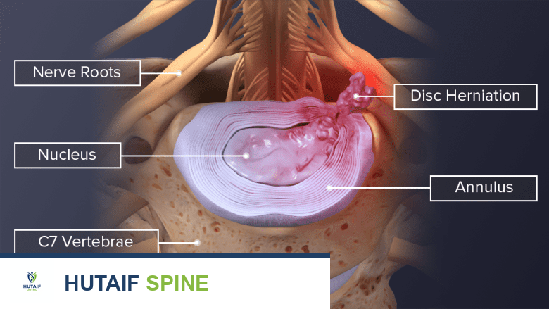 Illustration showing cervical vertebra with herniated disc.