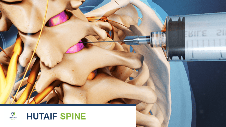 توضيح لعمود فقري عنقي بالغ مع إبرة محقونة في الفراغ العنقي.