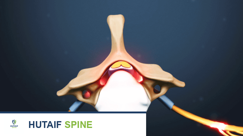 مرض القرص التنكسي: فهم تطوره، أعراضه، وخيارات العلاج الشاملة في صنعاء