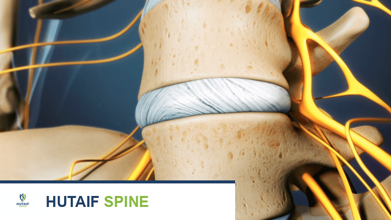 صورة طبية: مرض القرص التنكسي: دليل شامل للأسباب، الأعراض، وطرق العلاج مع الأستاذ الدكتور محمد هطيف