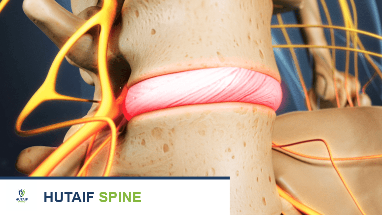 مرض القرص التنكسي: دليل شامل لفهم الأسباب والأعراض وخيارات العلاج المتاحة في صنعاء