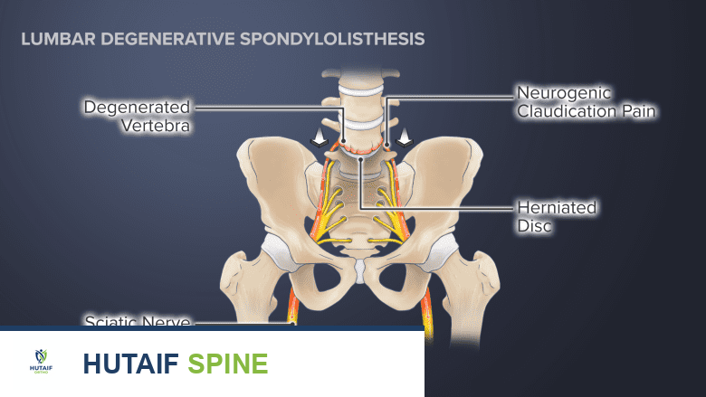 Illustration of a pelvis showing  sciatic nerve, neurogenic claudication pain, herniated disc.
