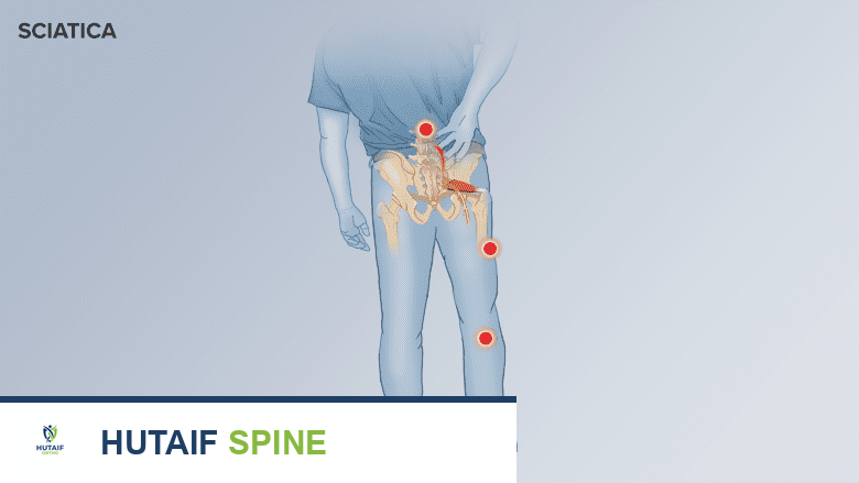 Illustration showing sciatica pain areas.
