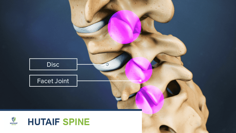 رسم توضيحي يظهر فقرات العمود الفقري القطني مع تبرز منطقة القرص باللون الأحمر، موضحًا تدهور القرص كجزء من تطور الانزلاق الفقاري.