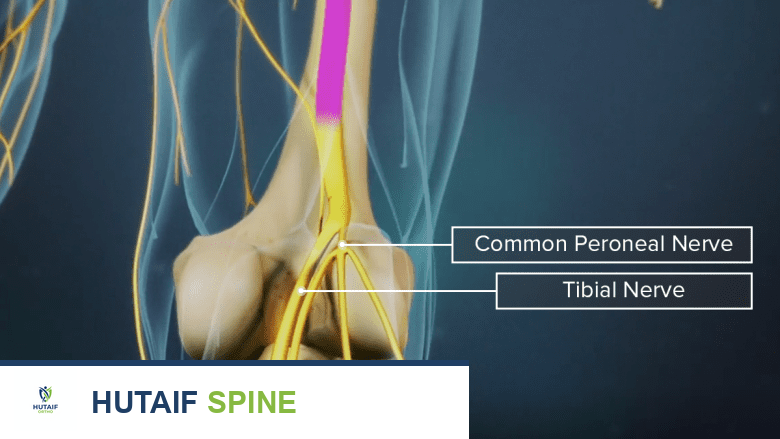 سقوط القدم: دليلك الشامل لتشخيص الأسباب والعلاج مع الأستاذ الدكتور محمد هطيف