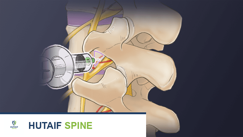 حقنة علاجية أو تشخيصية في فقرات الرقبة.