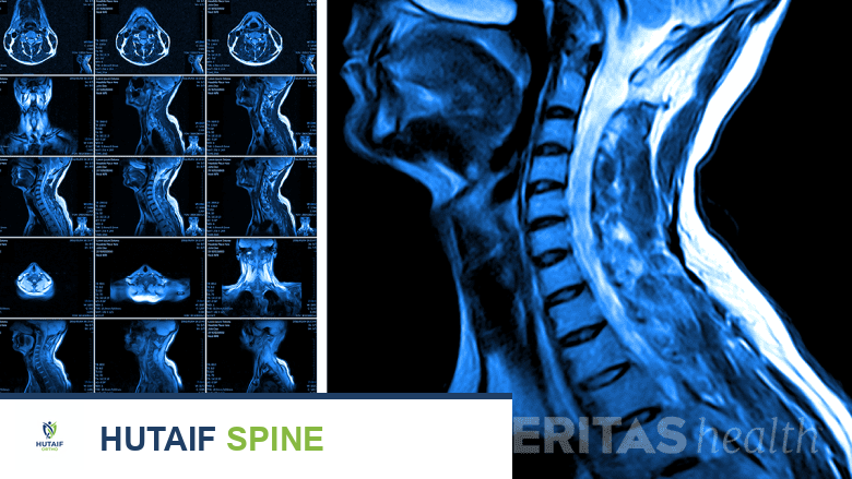 تضيق العمود الفقري العنقي واعتلال النخاع: دليل المرضى الشامل للتشخيص والعلاج