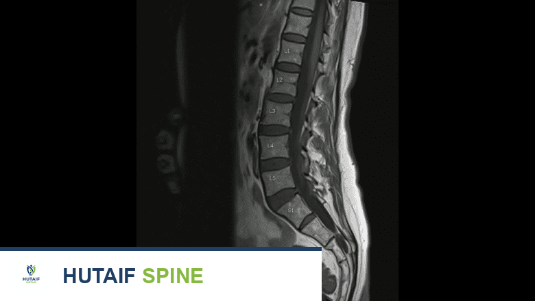 آلام الجزء العلوي من الظهر: دليل شامل للتشخيص والعلاج الفعال مع الأستاذ الدكتور محمد هطيف في صنعاء