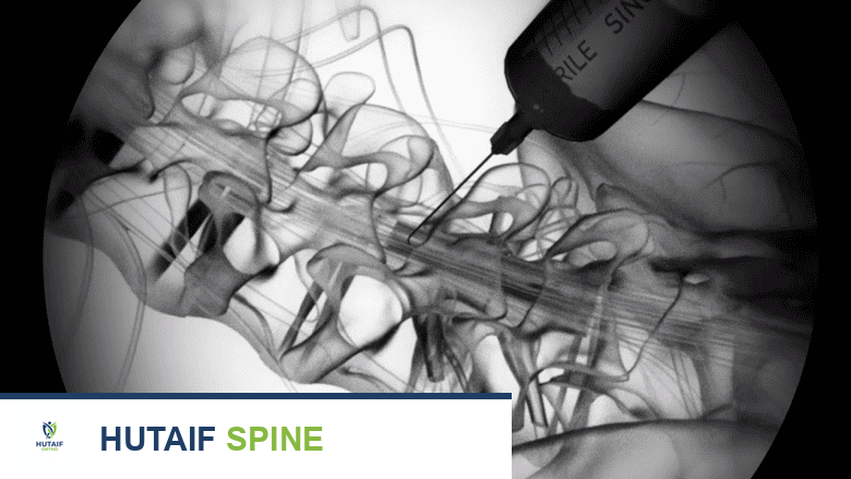 إبرة يتم إدخالها في الفراغ فوق الجافية.