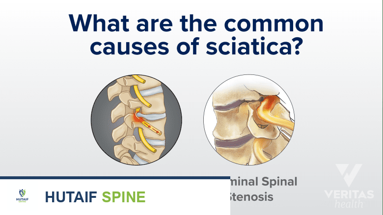 الأسباب الشائعة لعرق النسا.
