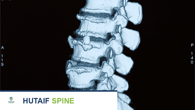 صورة بالأشعة السينية لأسفل العمود الفقري من المنظر الجانبي.