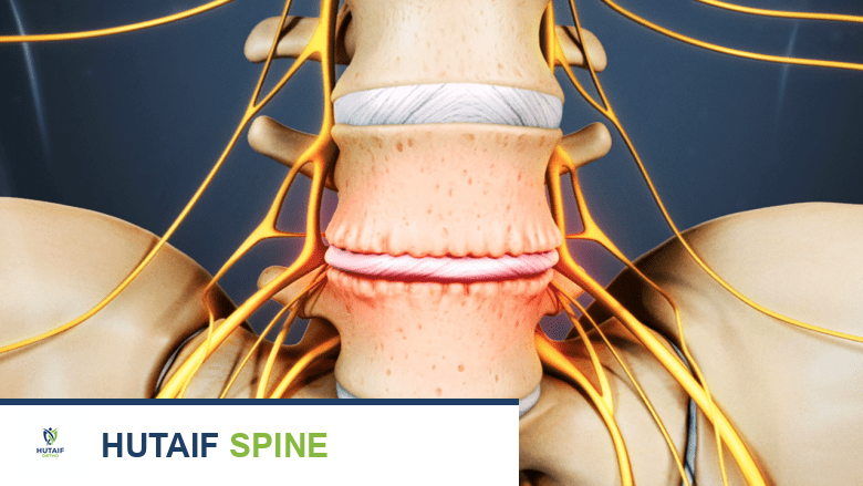 قرص فقري متدهور بين الفقرتين L4-L5.