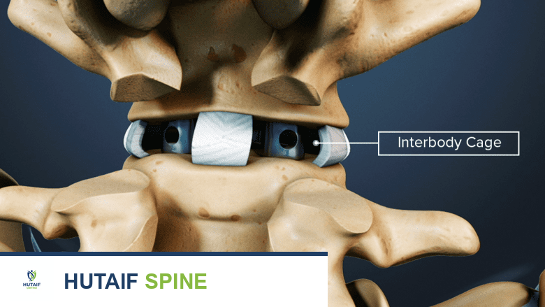 صورة توضح بعض إجراءات دمج الفقرات بين الأجسام الفقارية التي تستخدم أقفاصًا لحمل الطعوم العظمية.