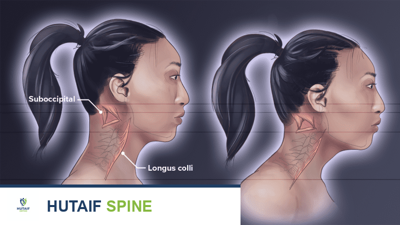 وضعية الرأس الأمامية: فهم تأثيرها على عضلات الرقبة وطرق العلاج مع الأستاذ الدكتور محمد هطيف