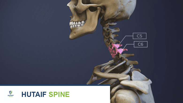 نموذج ثلاثي الأبعاد لقطعة العمود الفقري C5-C6.