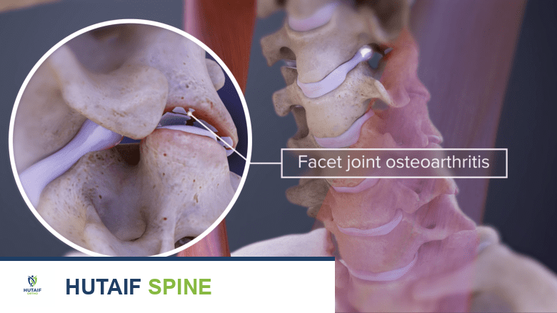 وضع الرأس الأمامي وتأثيره على العمود الفقري العنقي: دليل شامل من الأستاذ الدكتور محمد هطيف