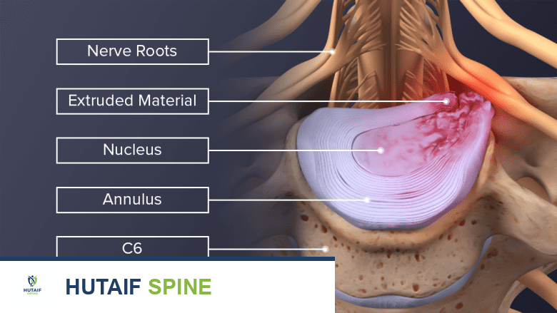 مرض القرص التنكسي العنقي: الأسباب، الأعراض، والحلول الشاملة مع الأستاذ الدكتور محمد هطيف في صنعاء