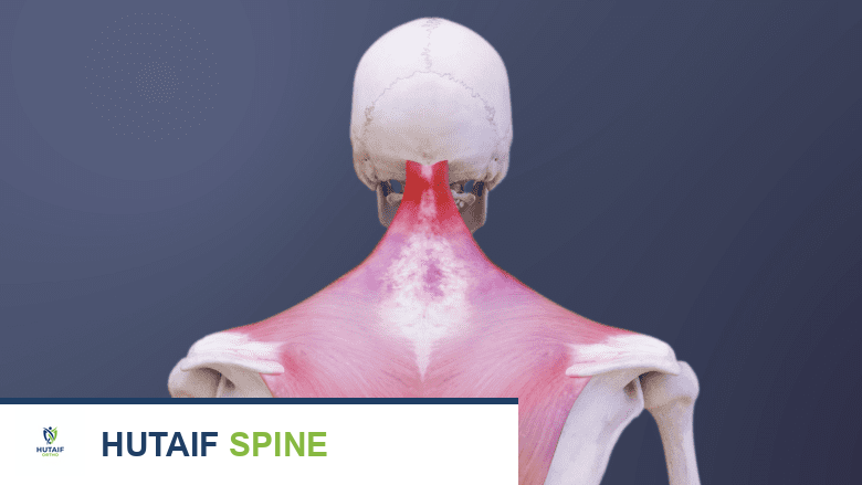 صورة ثلاثية الأبعاد توضح آلام الرقبة.