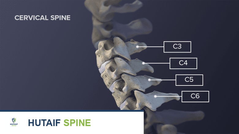 صورة توضيحية لـ مدى تأثير جراحة دمج الفقرات العنقية على حركة الرقبة: دليل شامل من الأستاذ الدكتور محمد هطيف
