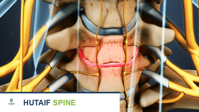 مرض القرص التنكسي في الرقبة.