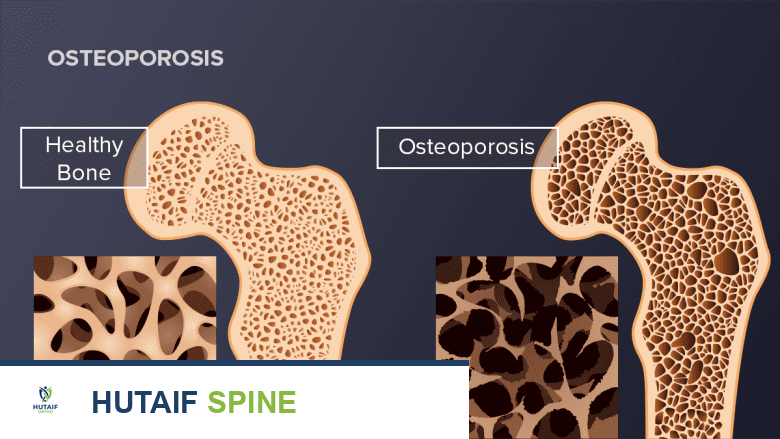 صورة توضيحية لـ المشي لصحة الظهر: دليلك الشامل لتخفيف الألم وتقوية العمود الفقري مع الأستاذ الدكتور محمد هطيف