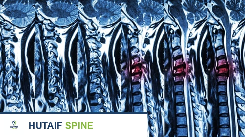 Multiple MRI views of a spine.