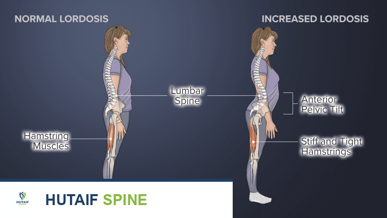 شد في أوتار الركبة وزيادة في تقوس الظهر