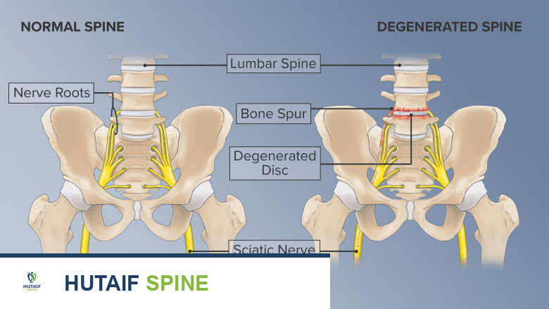 توضيح طبي: الانزلاق الفقاري البرزخي: دليل شامل للمرضى مع الأستاذ الدكتور محمد هطيف