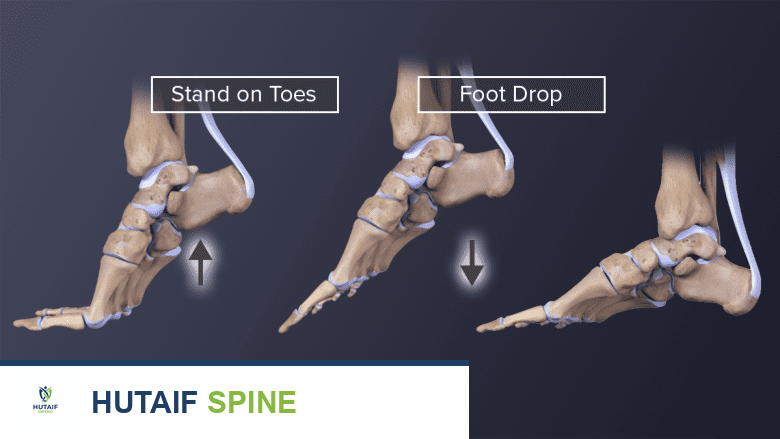 توضيح طبي: الانزلاق الفقاري البرزخي: دليل شامل للمرضى مع الأستاذ الدكتور محمد هطيف