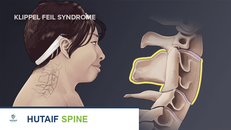 متلازمة كليبل فيل الأعراض، التشخيص، والعلاج على يد الأستاذ الدكتور محمد هطيف