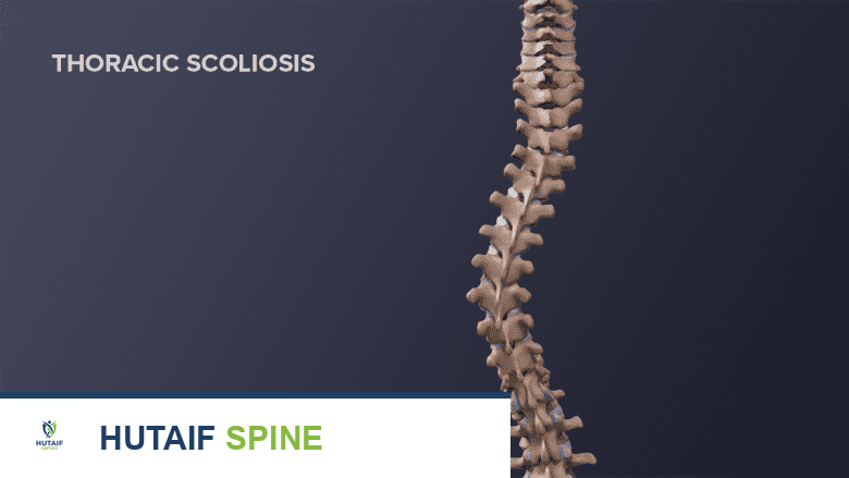 توضيح طبي يظهر عموداً فقرياً بالغاً مصاباً بالجنف.