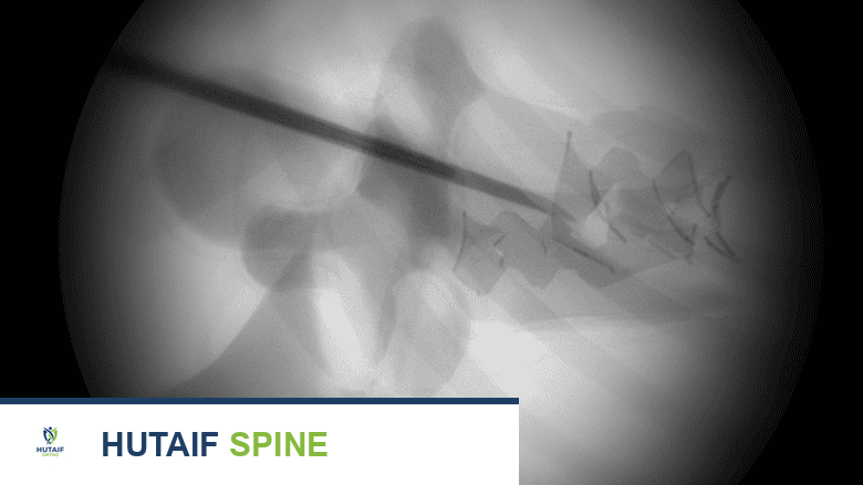 توضيح يظهر الأشعة السينية الفلورية.