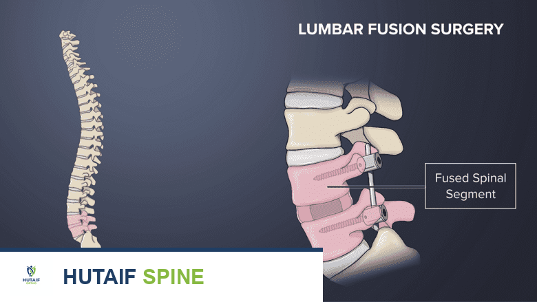 صورة توضيحية لـ علاج فقرات L4-L5: دليل شامل لآلام أسفل الظهر وعرق النسا مع الأستاذ الدكتور محمد هطيف