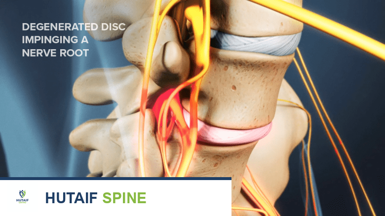 صورة توضيحية لـ آلام أسفل الظهر الأعراض التشخيص والعلاج مع الأستاذ الدكتور محمد هطيف